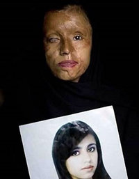Mujer quemada con ácido en Pakistán. Barbarie machista en estado puro...